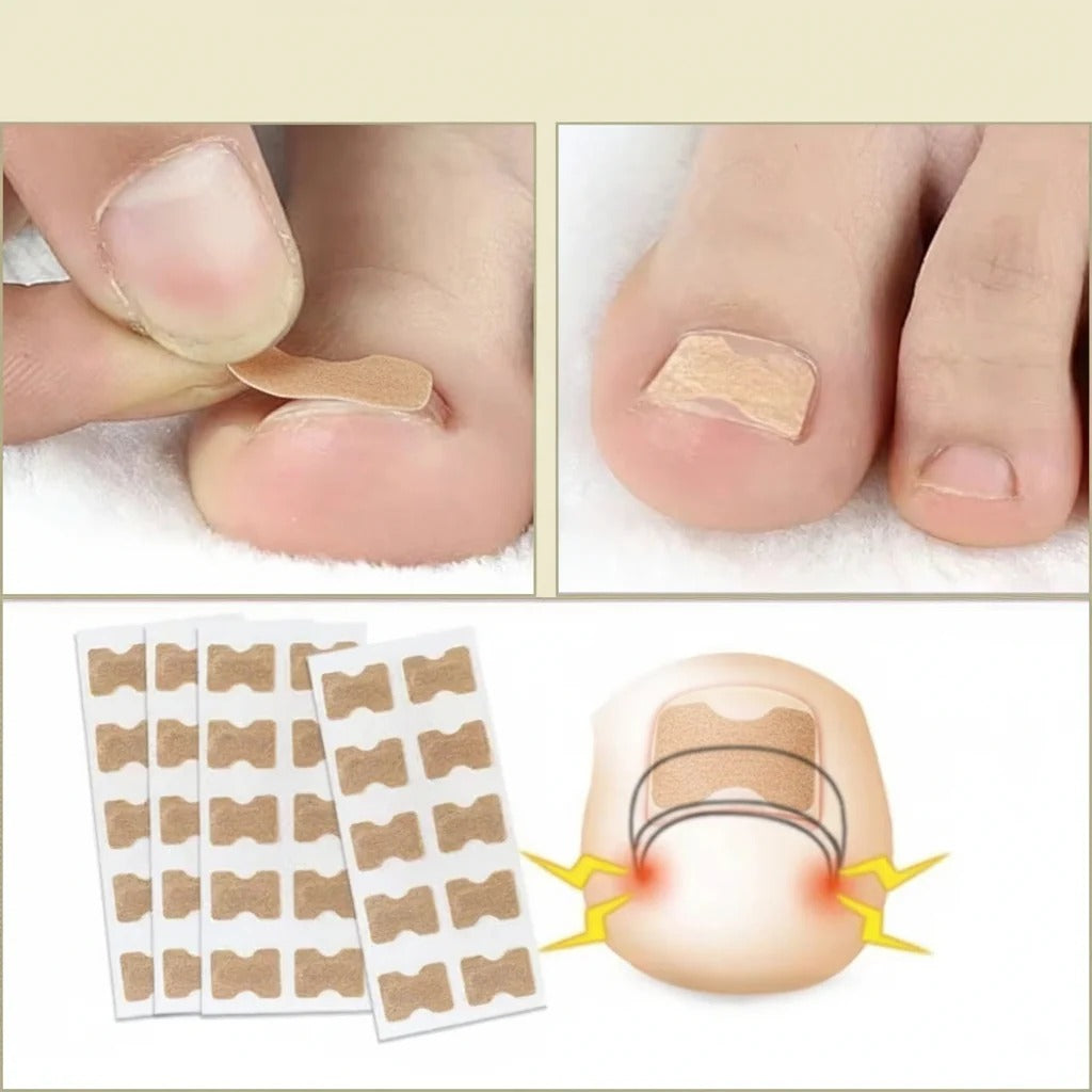 Nail Repair Patches Ingrown Toenails Instant Relief & Healing