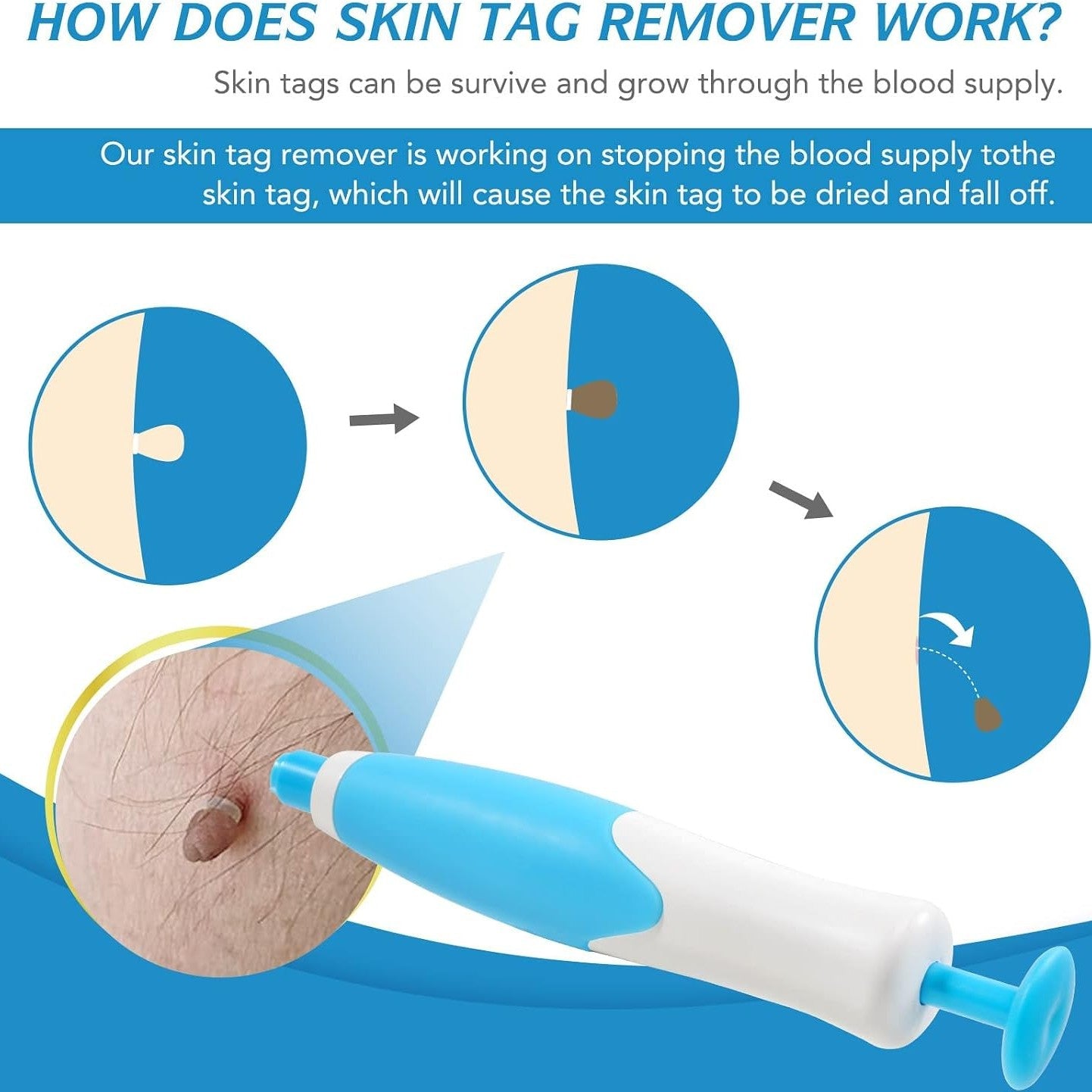 Auto Skin Tag Remover Kit Easy Removal Fast Results