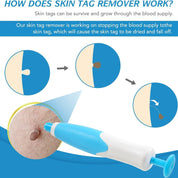Auto Skin Tag Remover Kit Easy Removal Fast Results