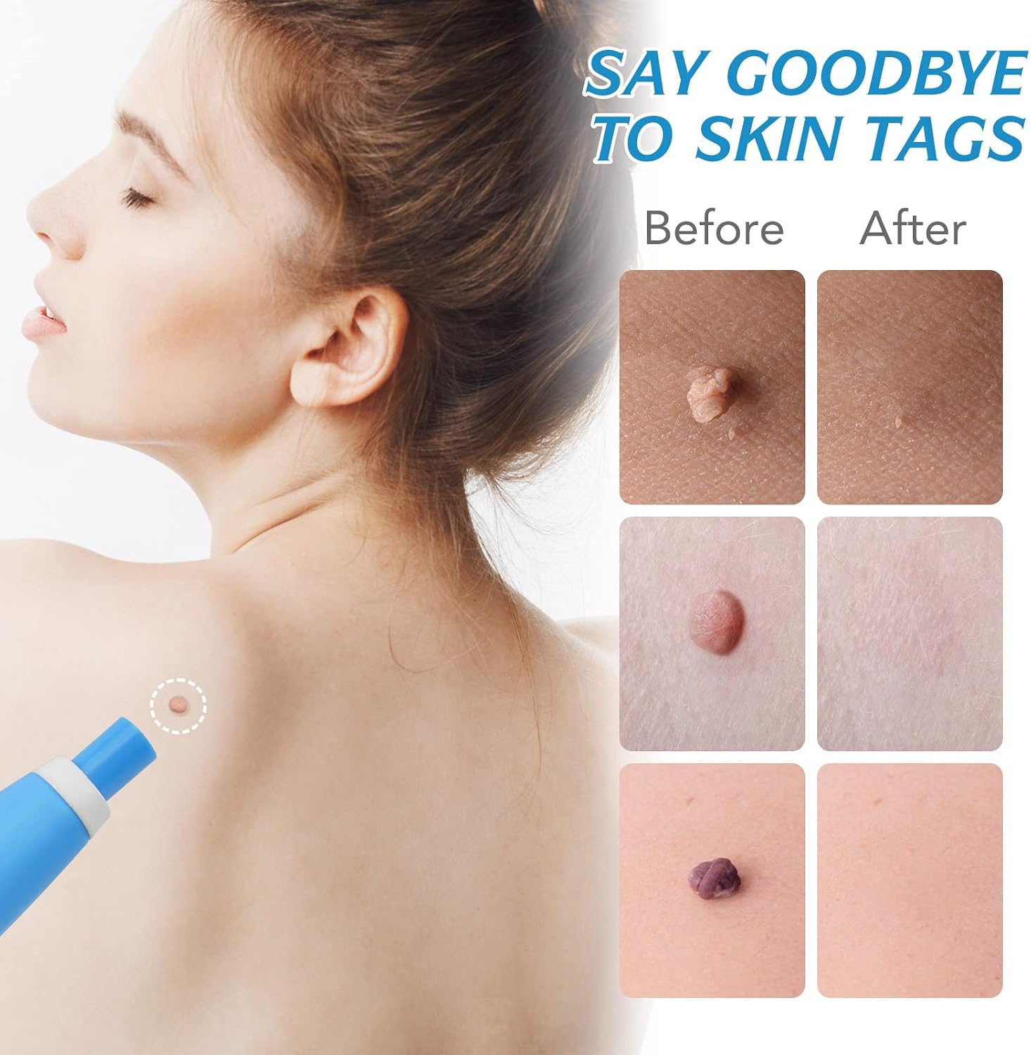 Auto Skin Tag Remover Kit Easy Removal Fast Results