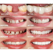 Instant Veneers Upper and Lower Jaw Natural Look Teeth Covering - Image 5