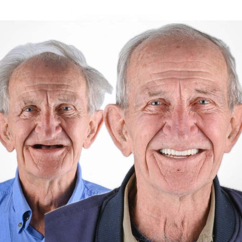 Natural-Looking Dentures Comfort and Confidence Smiles - Image 12