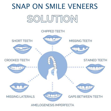 Smile Veneer Teeth Cover Set Instant Smile Makeover Upper & Lower - Image 6